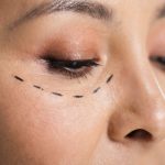 close up of asian woman with plastic surgery correction mark on face isolated on grey