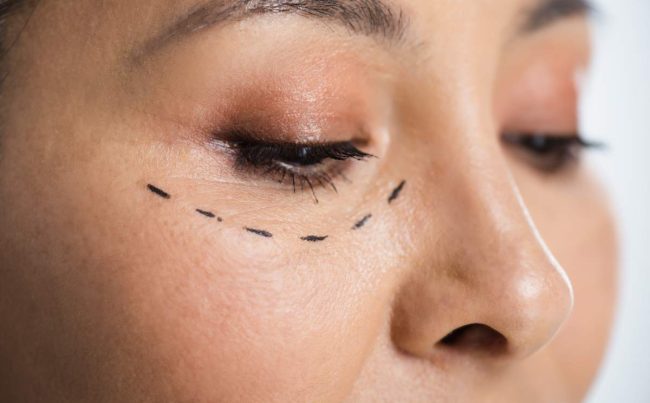 close up of asian woman with plastic surgery correction mark on face isolated on grey