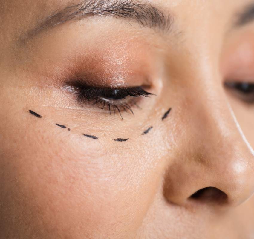 close up of asian woman with plastic surgery correction mark on face isolated on grey